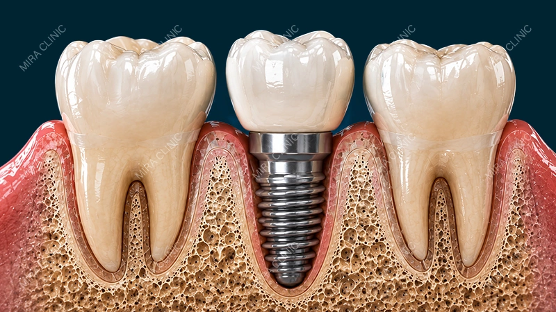 Gum and bone support